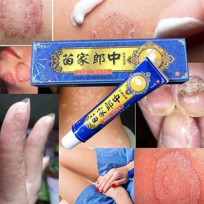 kem điều tri dứt điểm ngứa, viêm da