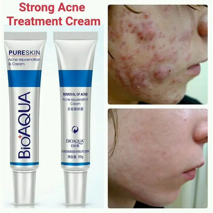 cream that can remove pimples