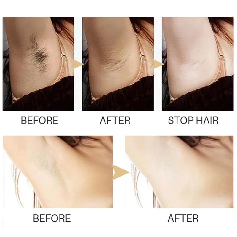 HeYang Permanent Hair inhibition Serum Painless Hair Remover Armpit Legs Arms Hair Growth Inhibitor Beauty Skin Care Body Essential Oil phone case.