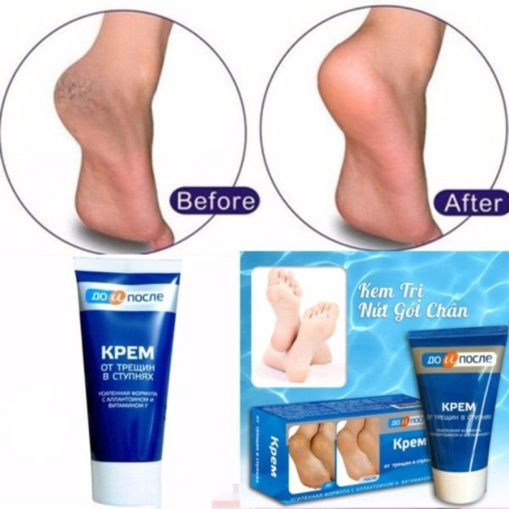 Kem dưỡng nứt gót chân KPEM Nga - Tuýp 50ml