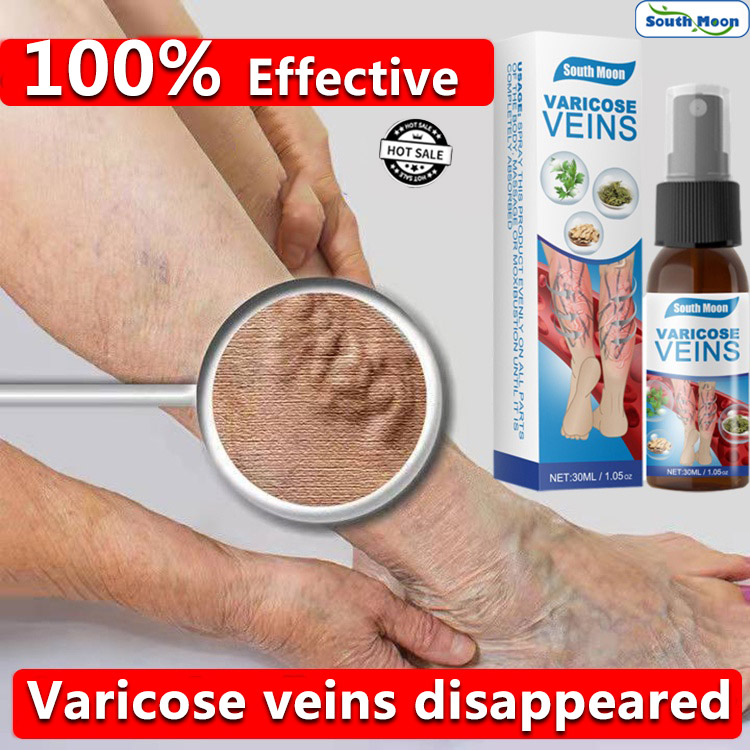 🔥Best seller🔥South Moon 30ML Veins Disappear，varicose veins remover for