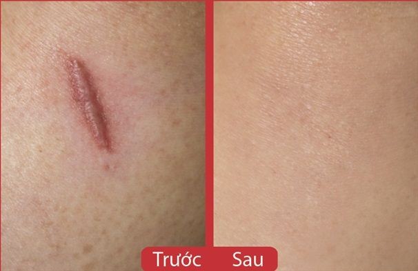 Miếng dán ép sẹo lồi ECLAR PLASTER (HISAMITSU Nhật bản)
