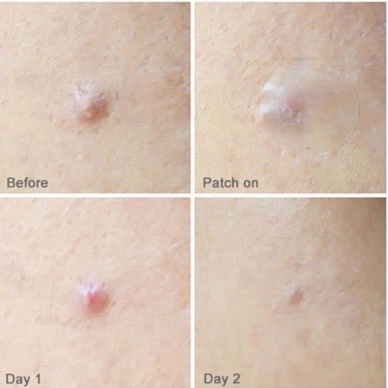 Miếng Dán Mụn Olive Young Care PlusScar Cover Spot Patch