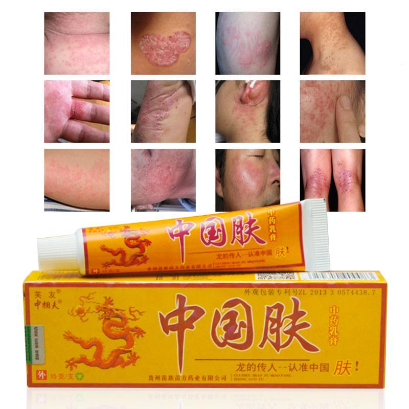 【NEW】 15g Natural Chinese Herbal Bacteria Cream Psoriasis Eczema ...
