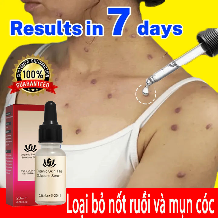 Wart Removal Serum Tẩy nốt ruồi xóa mụn ruồi trên mặt tàn nhang mụn cóc mụn thịt mụn cơm kem bôi rụng hết sạch mụn thịt thừa, mụn cóc, mụn nốt duồi，mụn ruồi, nám tàn nhang bay hết nhanh trong vong nhạc lọ 2 loại bỏ mụn trâu gây khó chịu.