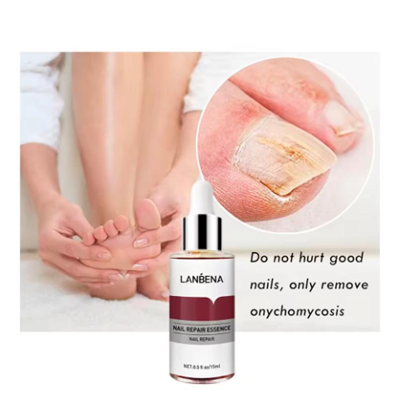 %E3%80%90Exclusive%20Discount%E3%80%91%20LANBENA%20Fungus%20Care%20Remove%20Onychomycosis%20Toes%20Nourish%20Brighten%20Hands%20Feet%20Product%20Repair%20Suitable%20Women%20Nail%20Pepair%20Essencs%20-%20Image%207
