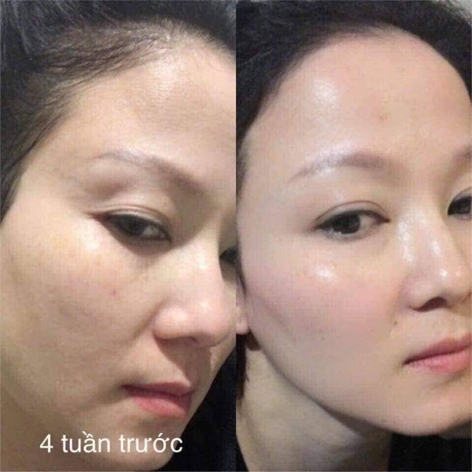 Tế Bào Gốc Ronas Stem ( Hộp 10 lọ ) Cell Hàn Quốc Chính Hãng