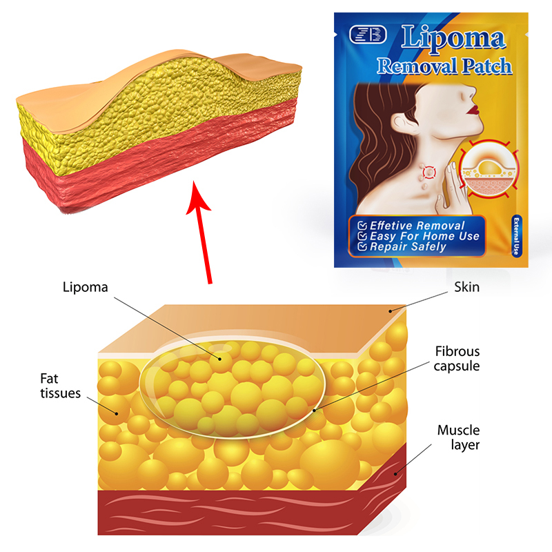 Tanggeri%20Fashion%206Pcs%20Lipoma%20Removal%20Paste%20Fatty%20Lump%20Removal%20Patch%20SKU:YG-2059@#SMT1234yjz%20-%20Image%204