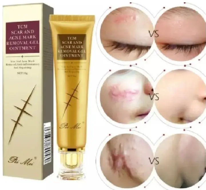 tcm acne scar removal