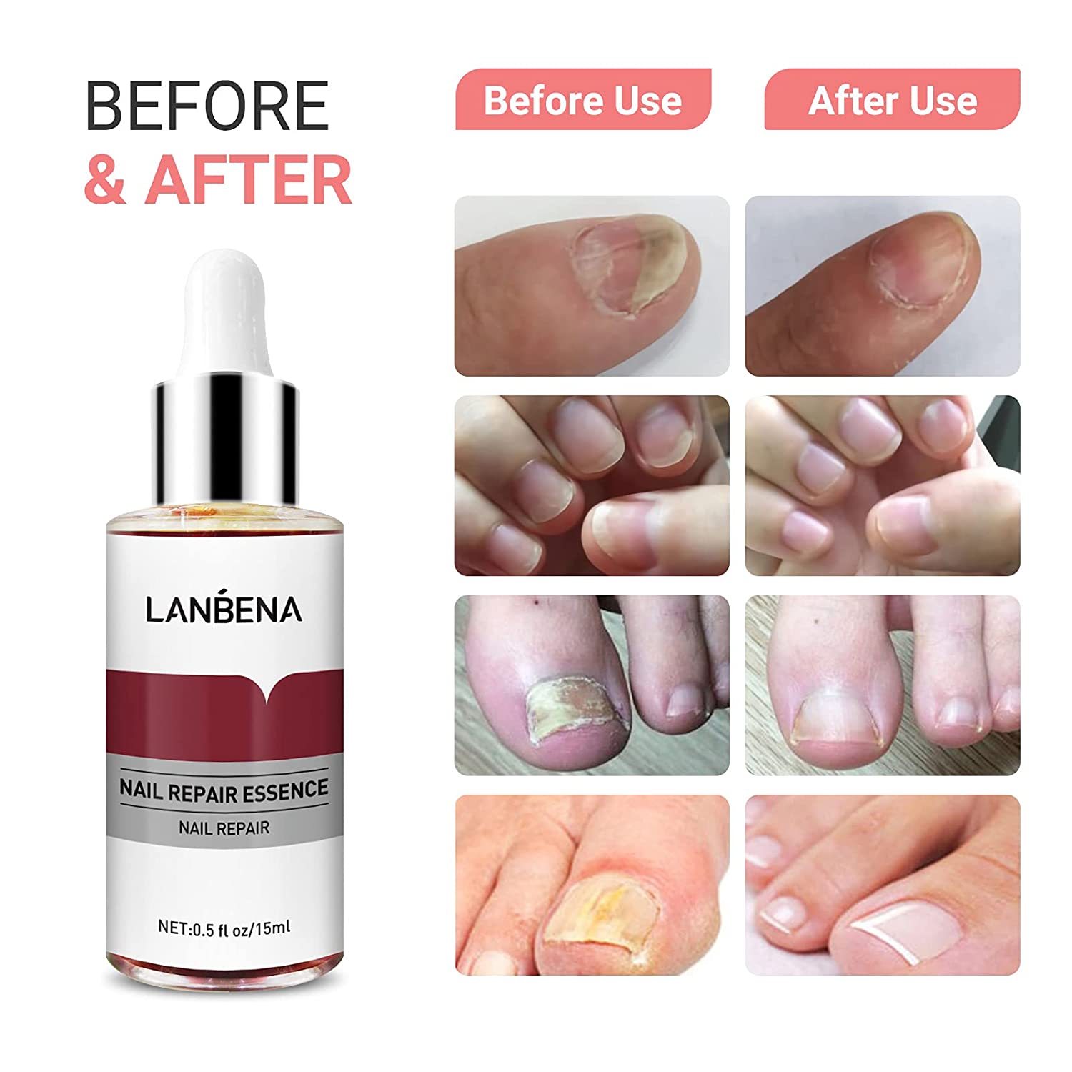 Anti Fungal Nail Infection Herbal Essence Nail Care Gel , Nail Repair  Essence Serum , Toenail and Nail Care Solution , Renewal , Fixes and  Restores Discolored and Damaged Nails Hand and