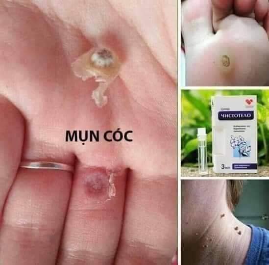 Gel tẩy nốt ruồi 12ml của Nga