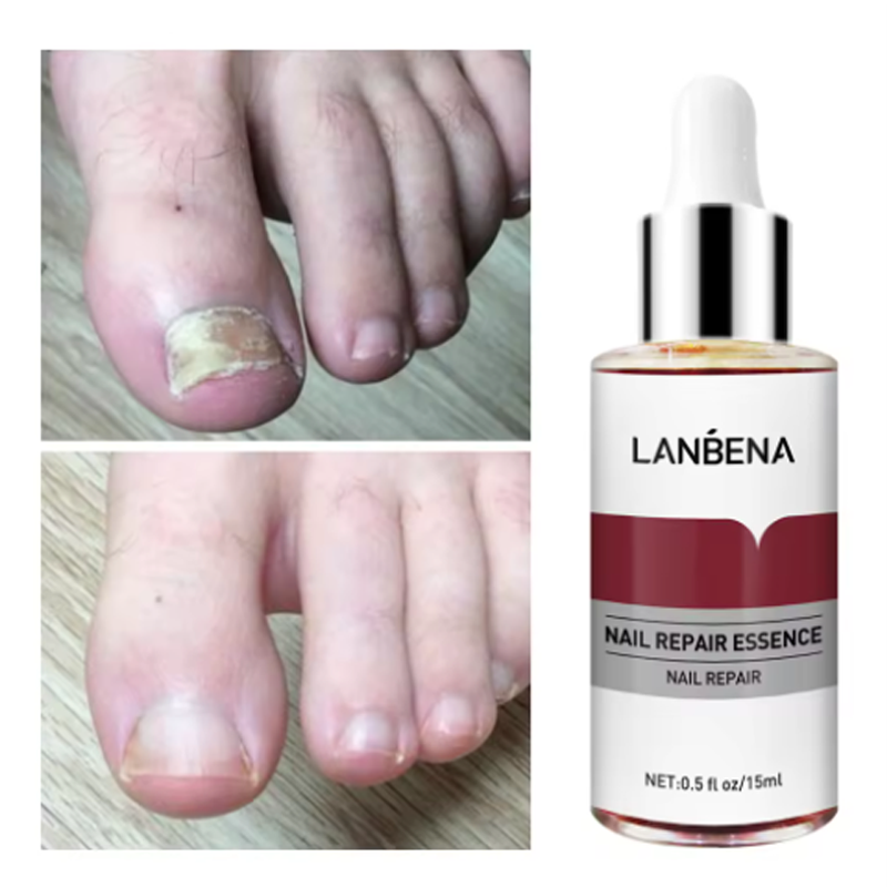 %E3%80%90Exclusive%20Discount%E3%80%91%20LANBENA%20Fungus%20Care%20Remove%20Onychomycosis%20Toes%20Nourish%20Brighten%20Hands%20Feet%20Product%20Repair%20Suitable%20Women%20Nail%20Pepair%20Essencs%20-%20Image%205