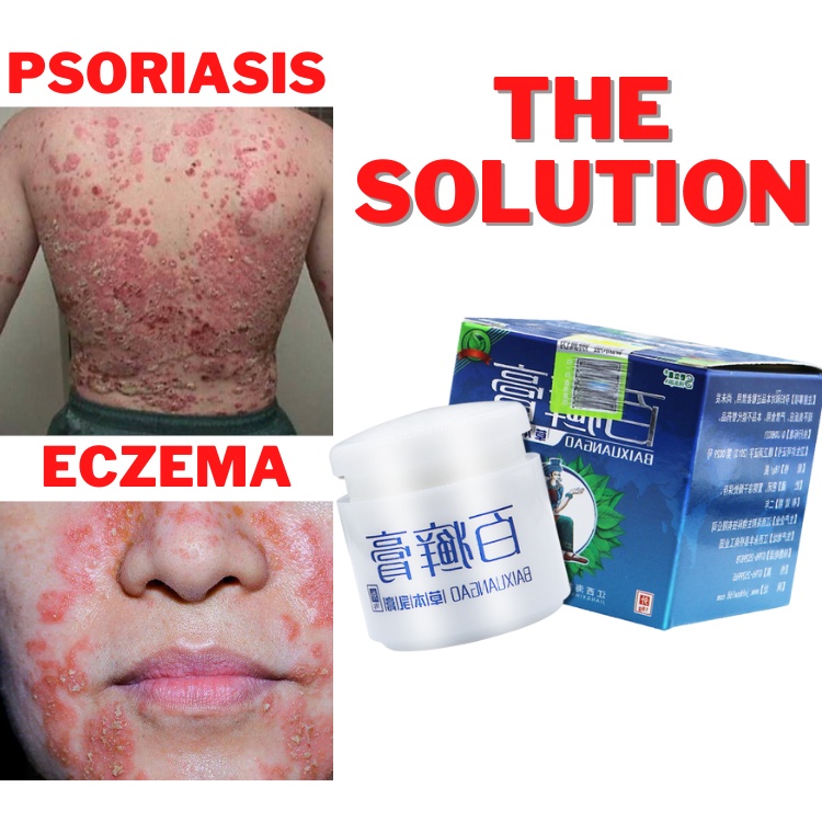 Baixuangao Ointment Advance natural herbal medicine for Psoriasis and