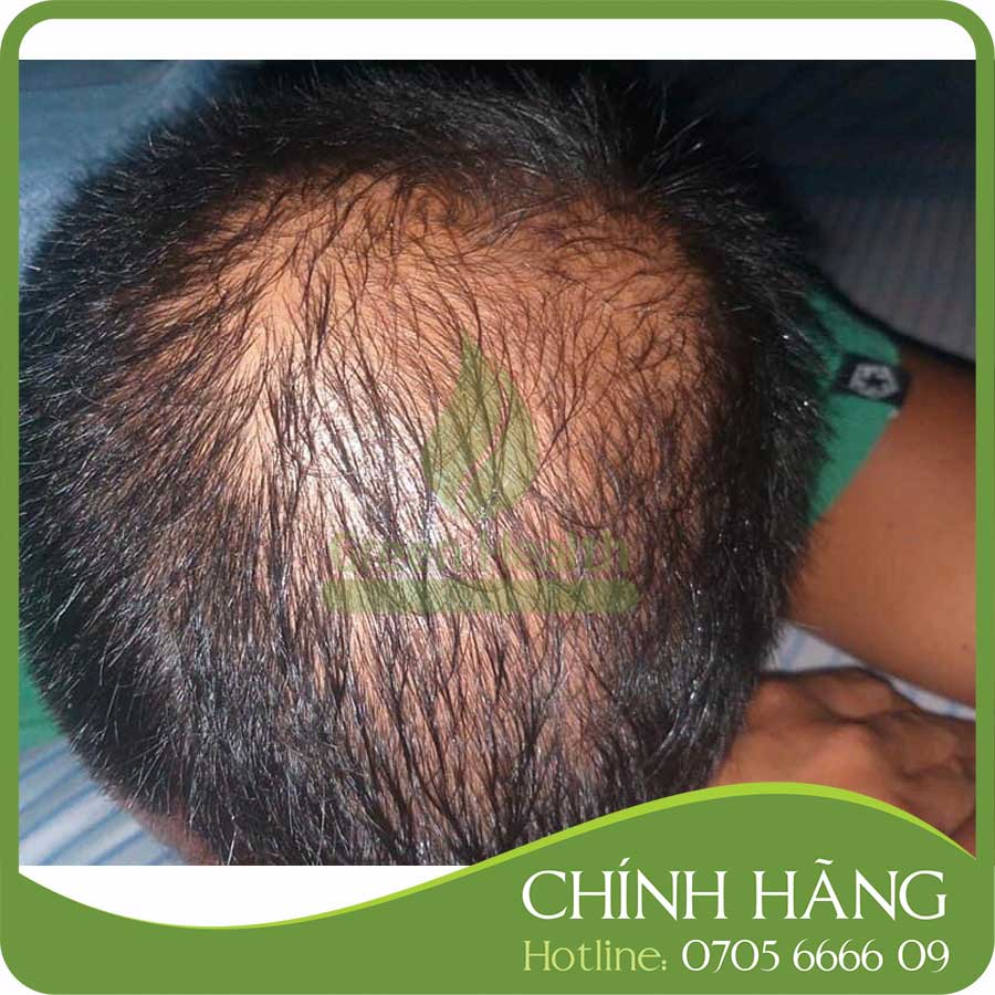 Dung dịch hỗ trợ mọc tóc Hair 4U Pro