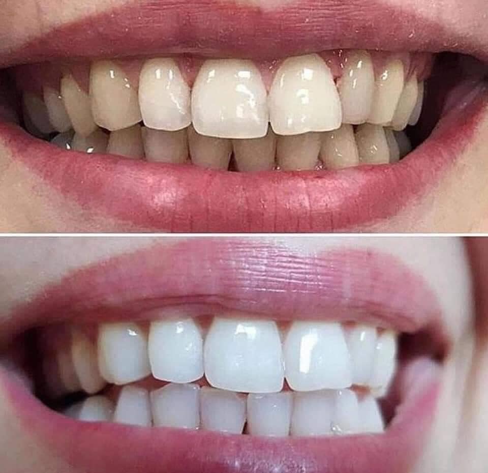 Combo kem đánh răng và bột làm trắng răng EUCRYL - ALISA