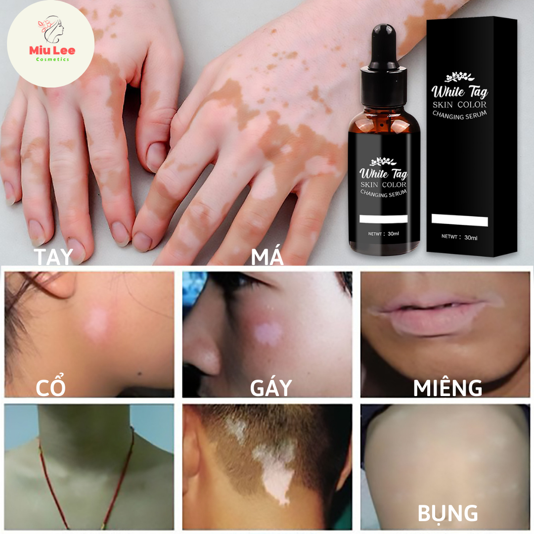Tinh chất hết bạch biến, đốm trắng, lang ben trên da hiệu quả White Tag