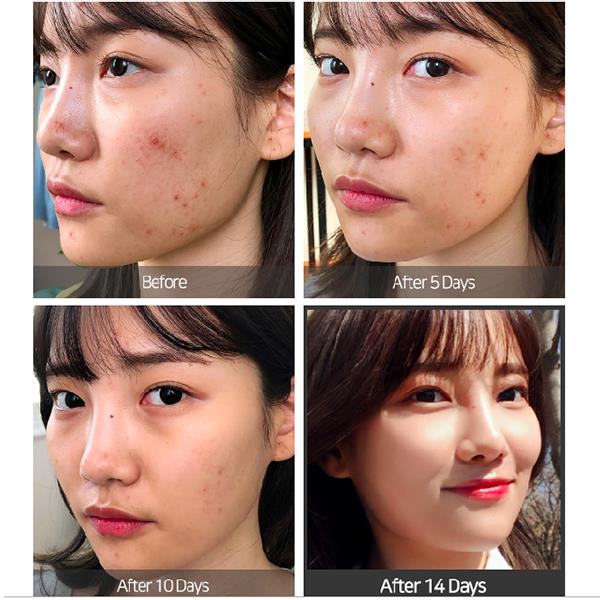 14 days super miracle spot all kill cream