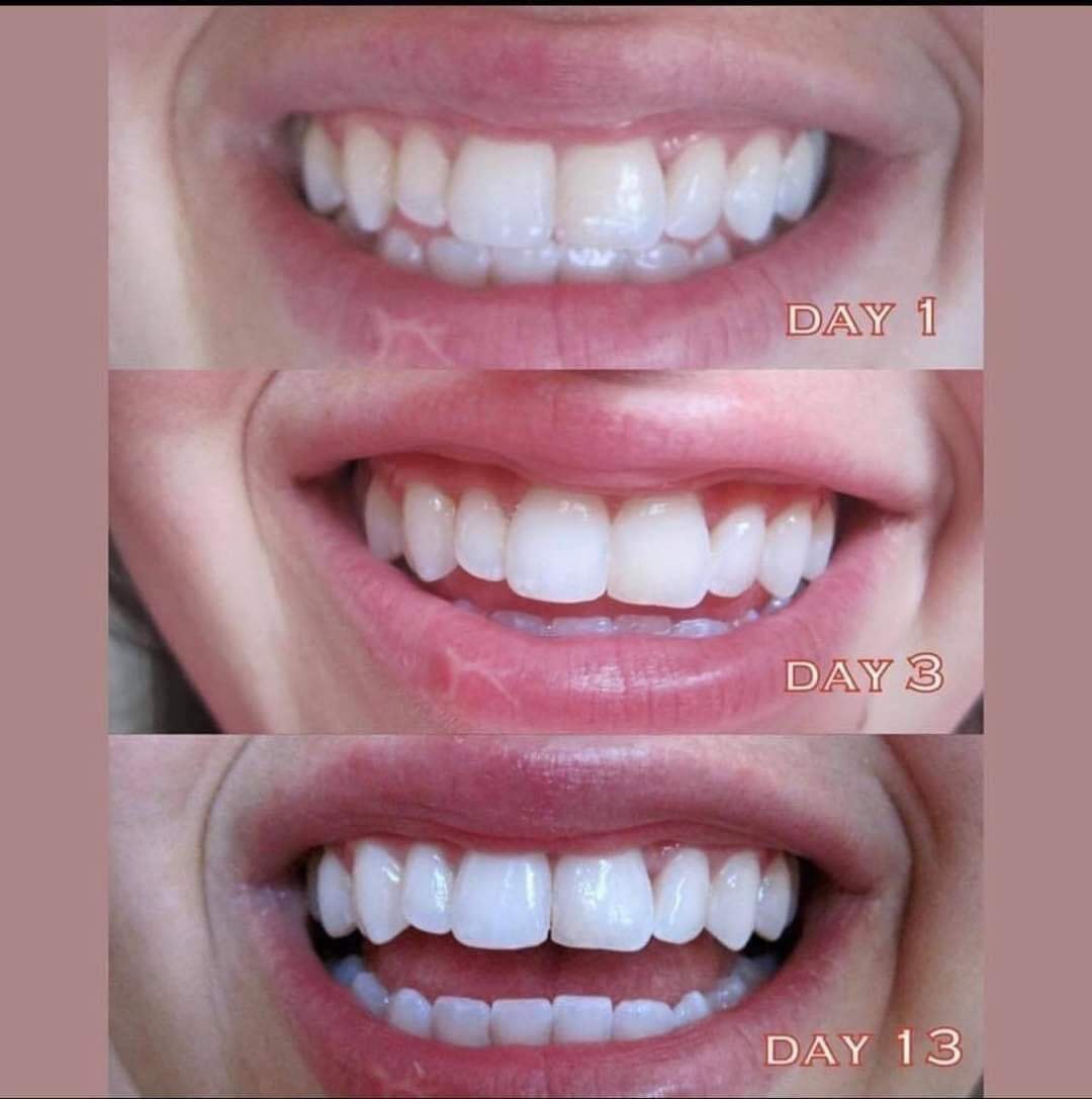 Kem đánh răng CREST 3D White Advanced Triple Whitening