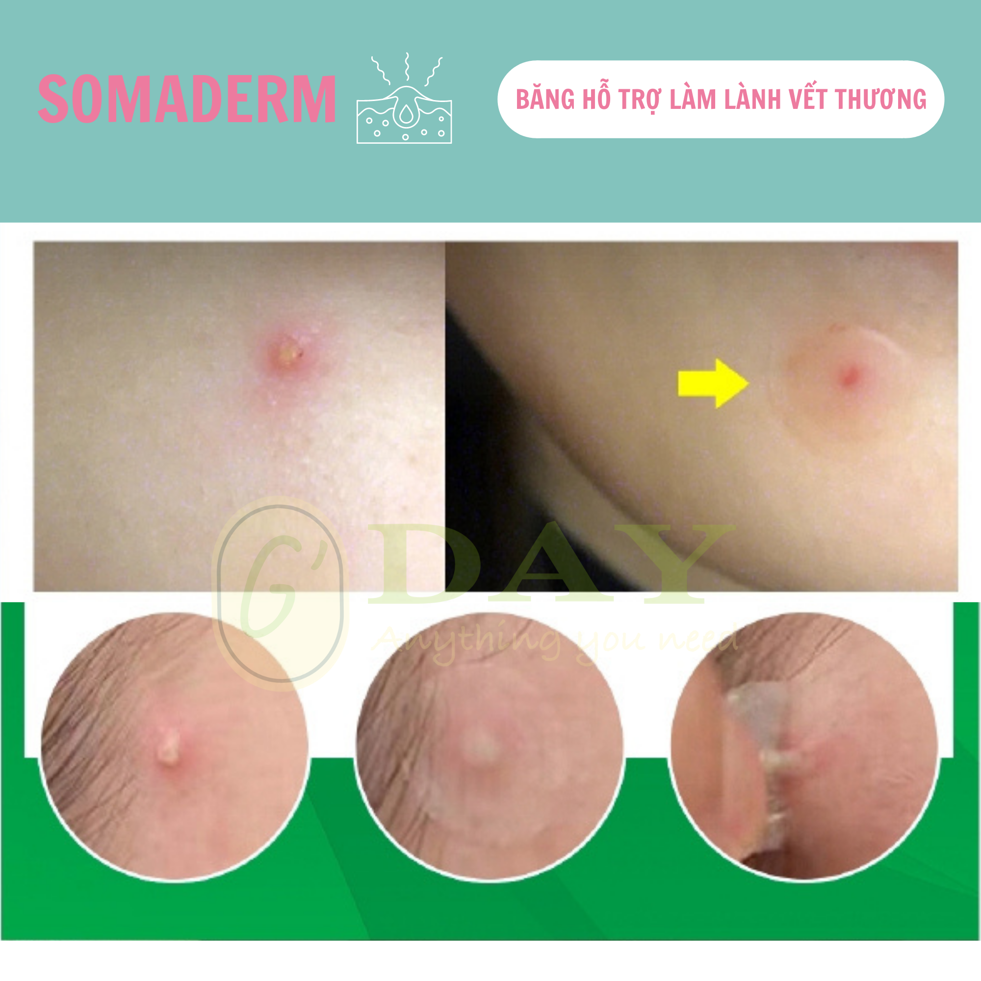 [CHÍNH HÃNG] Miếng Dán Mụn Somaderm Spot 18 miếng