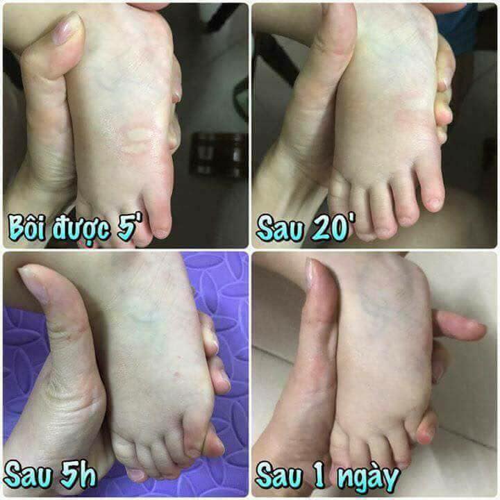 Cao bôi muỗi đốt côn trùng cắn Thái Lan