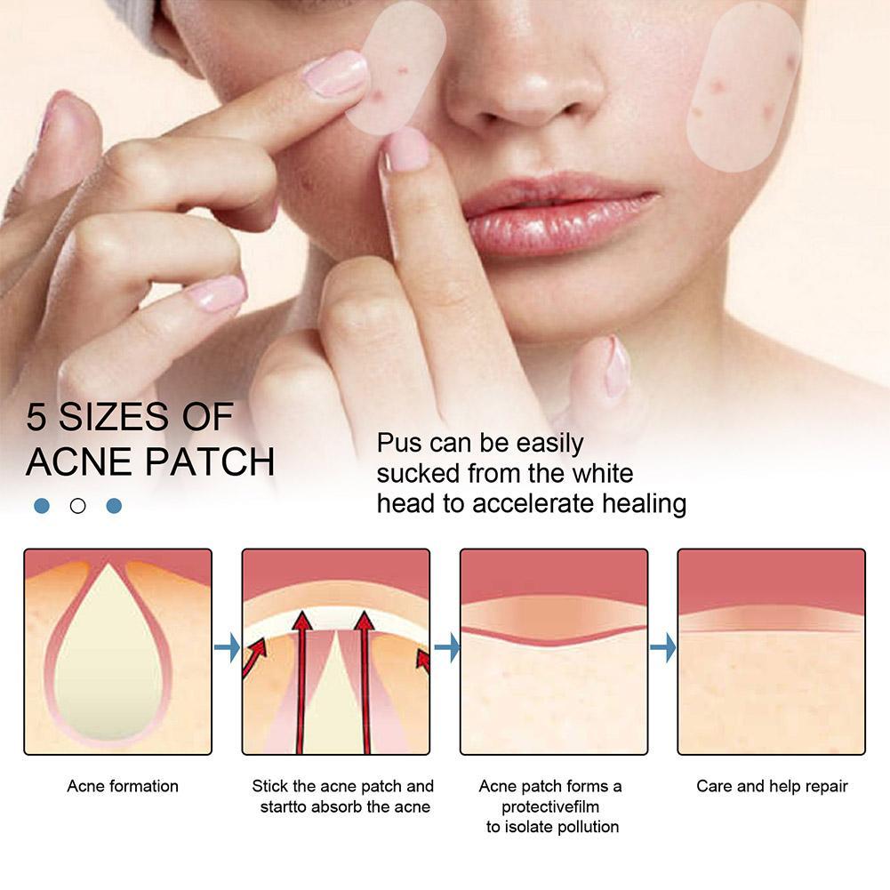 Yuanyan%2080pcs/set%20Large%20Size%20Acne%20Pimple%20Patch%20Face%20Treatment%20Invisible%20Tools%20Acne%20Remover%20Blemish%20Pimples%20Stickers%20D3T7%20-%20Image%206