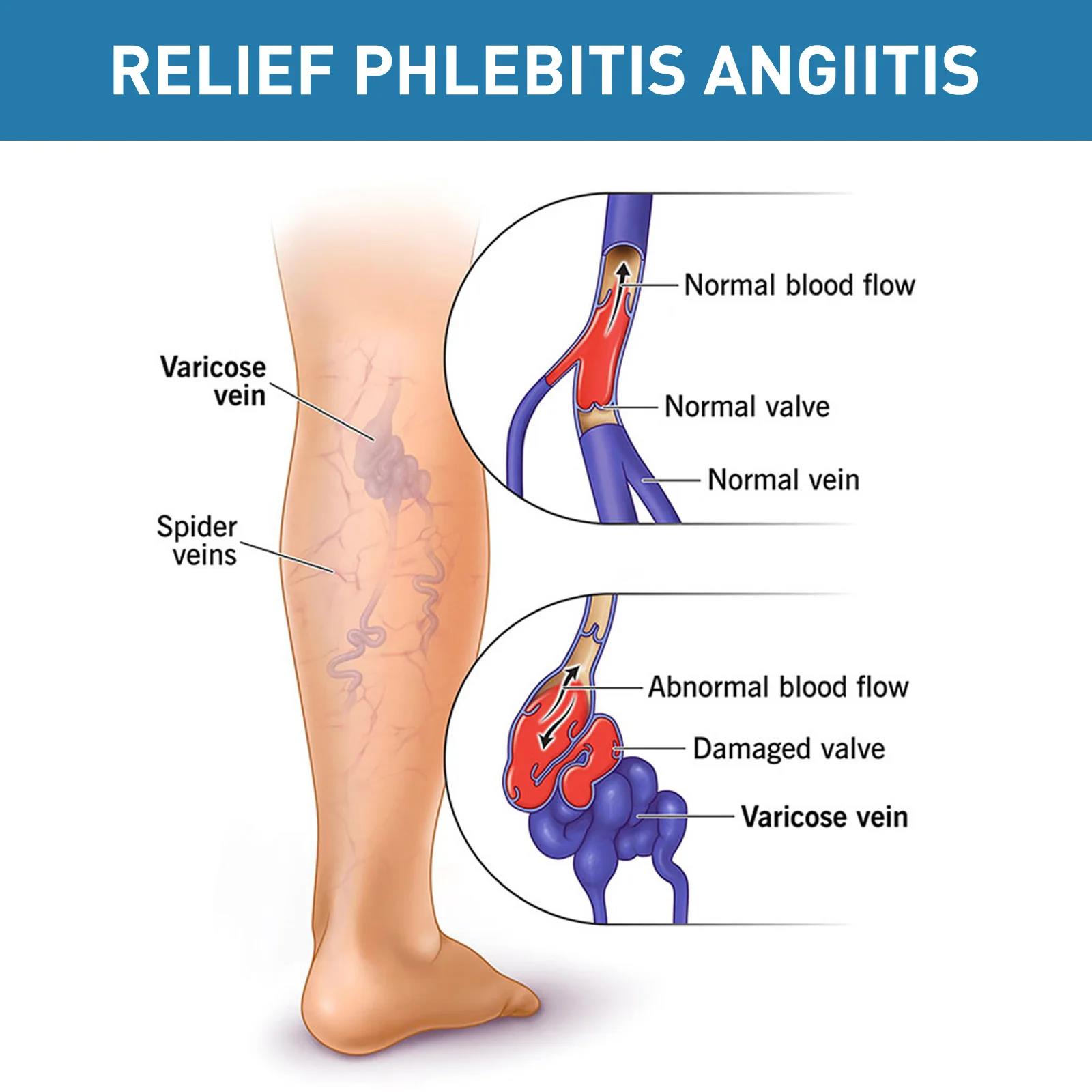 Relieve%20Vasculitis%20Cream%20Phlebitis%20Worm%20Spider%20Legs%20Vessel%20Pain%20Treatment%20Soothing%20Reduce%20Swelling%20Varicose%20Vein%20Relief%20Ointment%20-%20Image%203