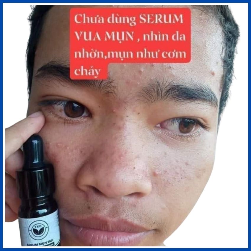 Serum Mụn Trần Kim Huyền