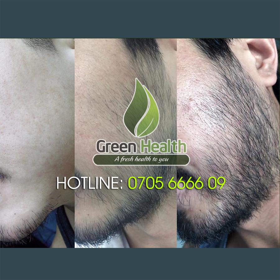 Serum Hỗ Trợ Mọc Râu Quai Nón Minoxidil 12,5% Morr