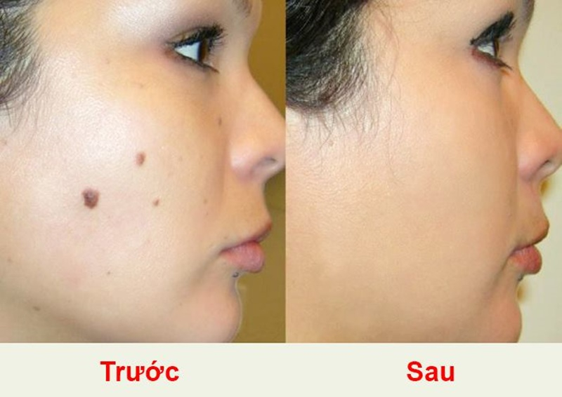 Gel Chấm Xóa Tàn Nhang, Nốt Ruồi Nga
