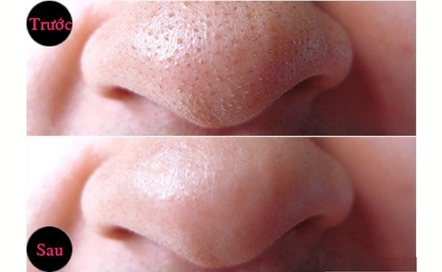 Combo 3 hủ gel mặt nạ lột mụn TiTiOne