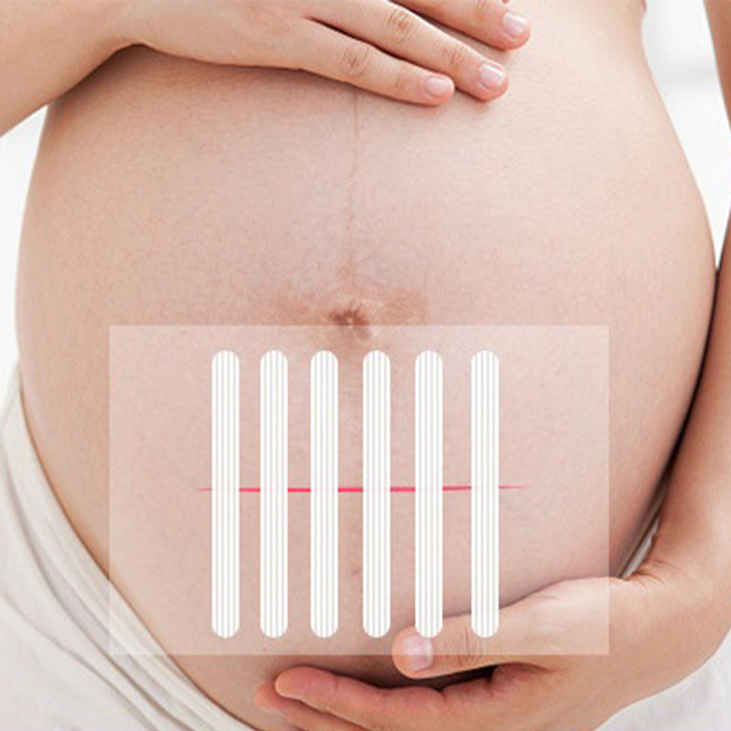 Wound%20Skin%20Closure%20Strips%20Postpartum%20Wound%20Repair%20Cosmetic%20Surgery%20Seam-Free%20Adhesive%20Medical%20Suture%20Free%20Surgical%20Tape%20XINYAN%20-%20Image%202