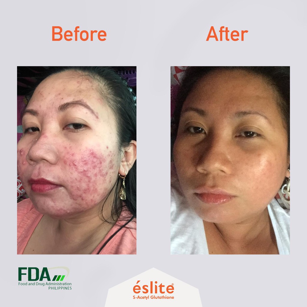glutathione injection face cream review Review on Glutathione Injection Face Cream and Smooth as Silk Soap