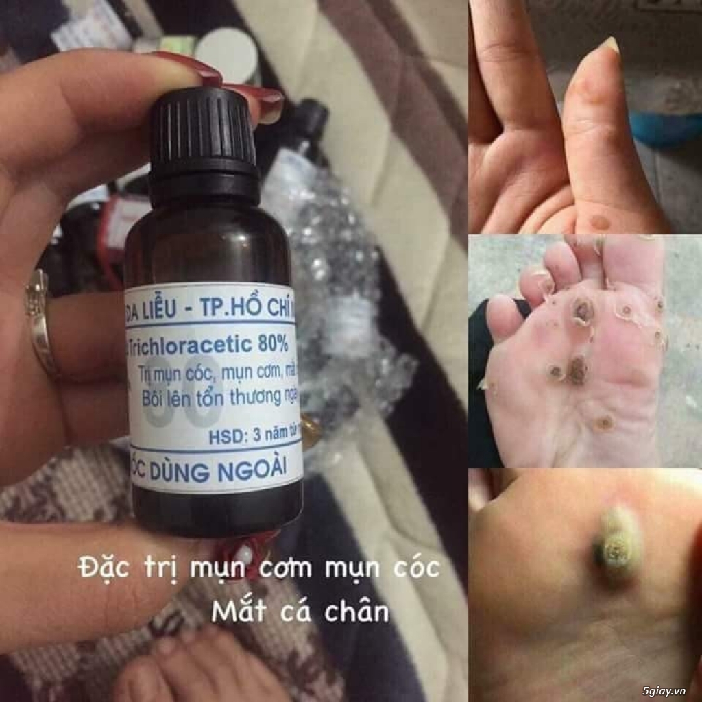 Lọ bôi loại mụn cóc, mụn cơm, mụn thịt, mắt cá chân