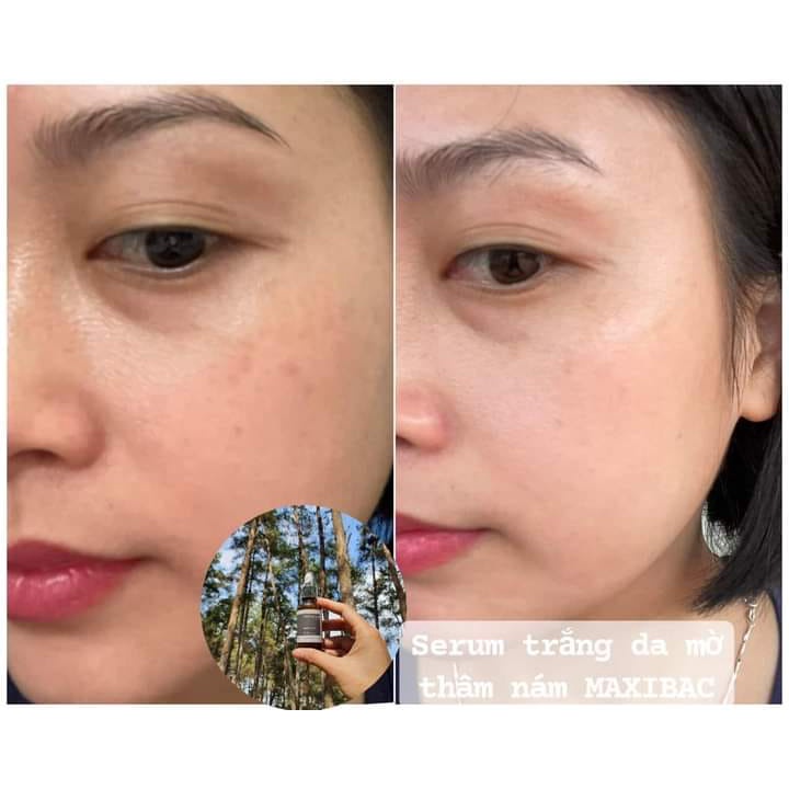 Maxibac Whitening Serum - Serum mờ ƞám dưỡng trắng da Maxibac