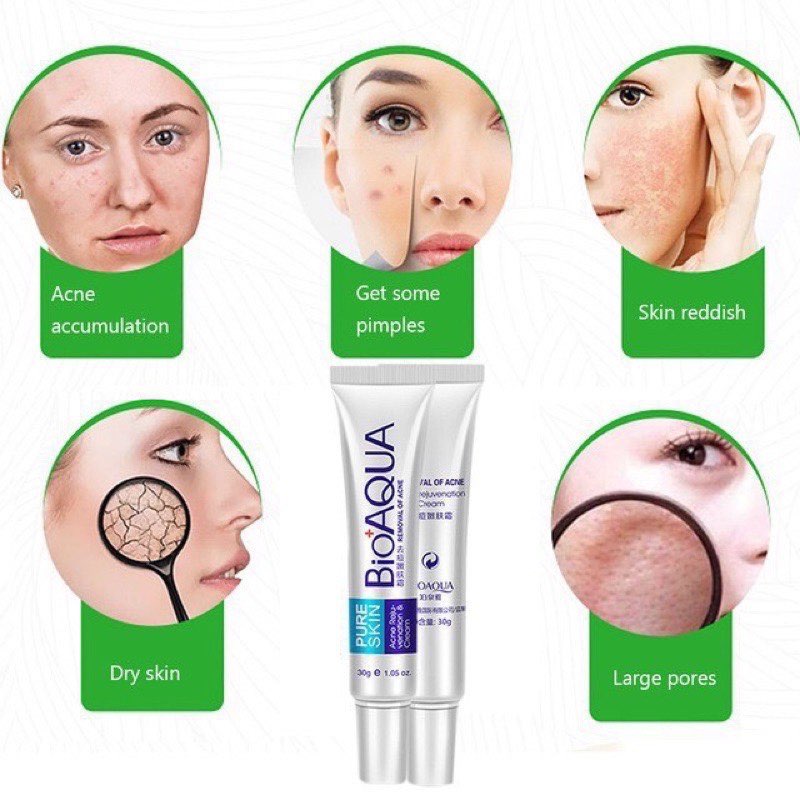 ACNE & PIMPLES REMOVAL CREAM BIOAQUA for Acne Scar Mark Remover Lazada PH