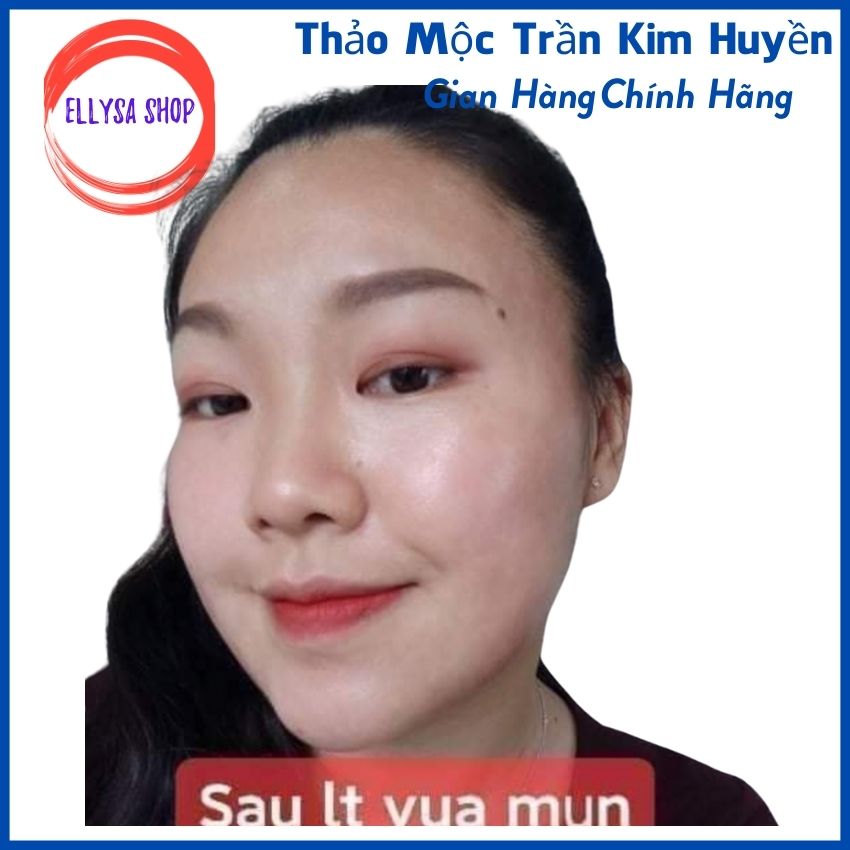 Serum Mụn Trần Kim Huyền