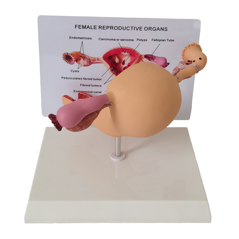 【Latest Style】 anatomical female uterus ovary model with pathologies