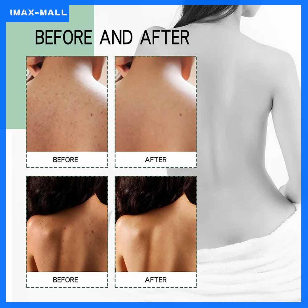 Bình xịt dưỡng mụn ở lưng