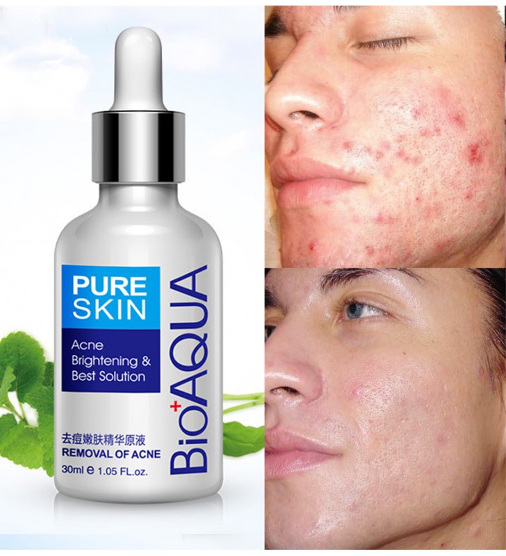 serum to treat acne