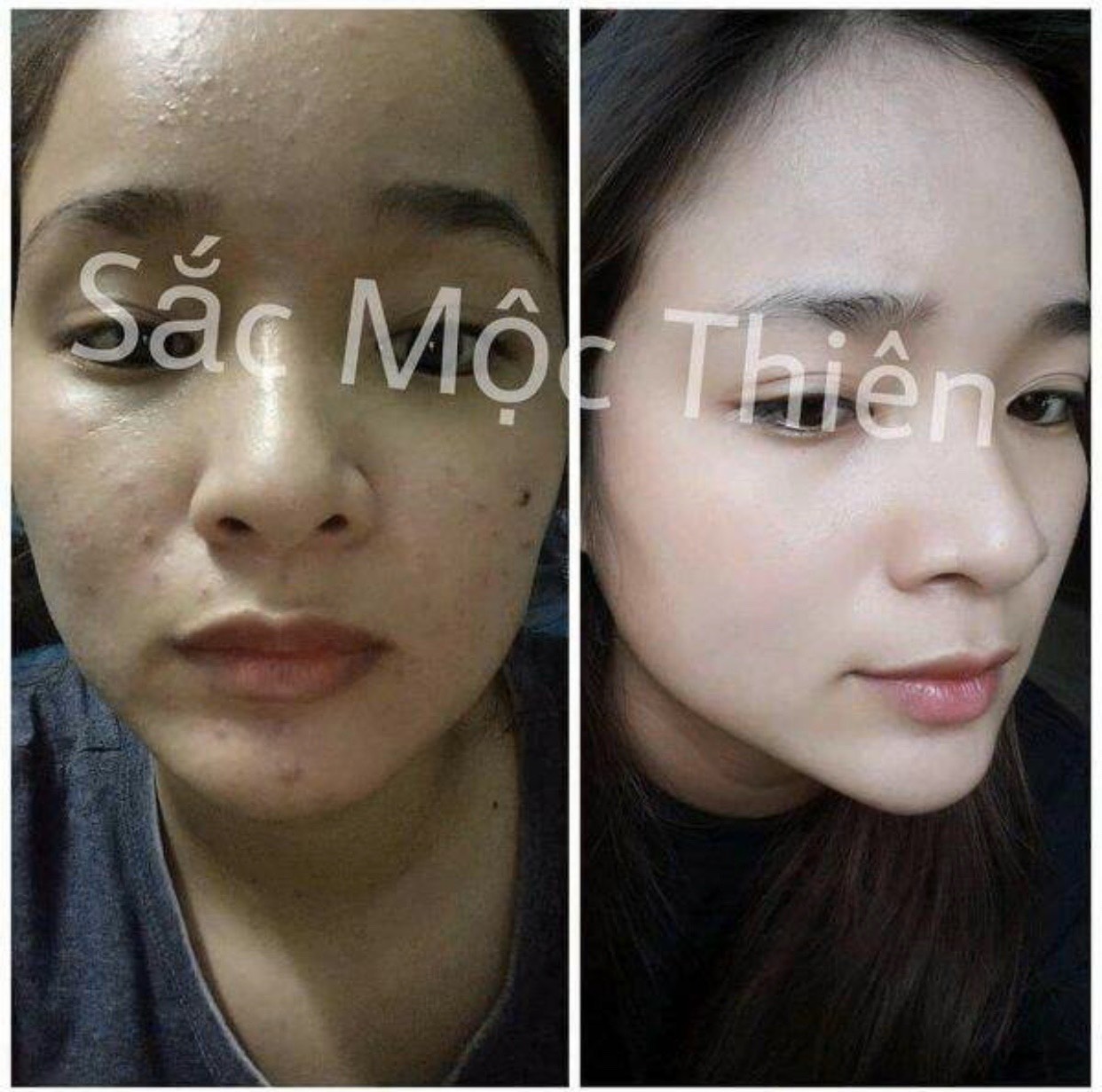 Mặt Nạ Thải Độc Tố Mụn Ẩn Sắc Mộc Thiên