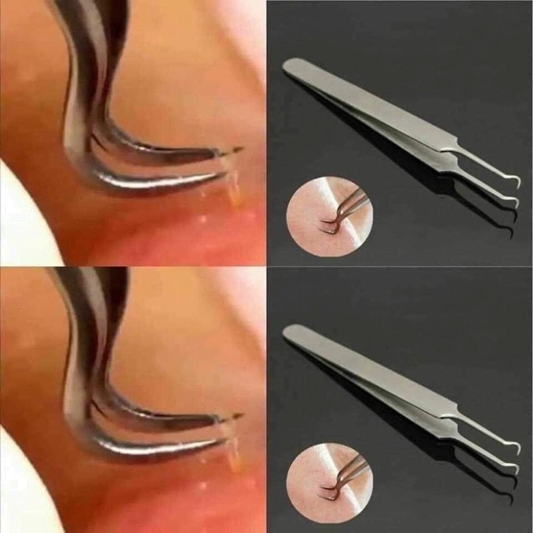 NHÍP GẮP MỤN THẦN THÁNH HÀN QUỐC